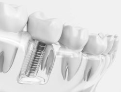 Implan Gigi, Solusi Modern untuk Gigi Hilang