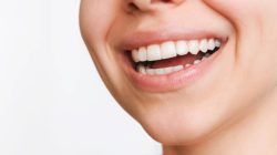 Perbedaan Bleaching dan Scaling Gigi: Fungsi dan Manfaatnya